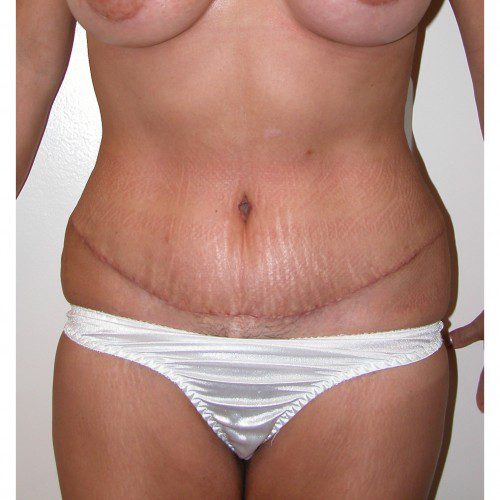 Abdominoplasty 2 After Photo 