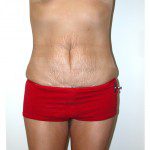 Abdominoplasty 2 Before Photo - 3