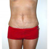Abdominoplasty 2