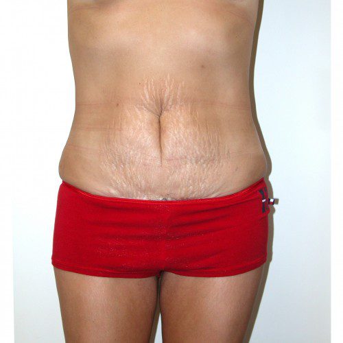 Abdominoplasty 2 Before Photo 