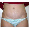 Abdominoplasty 5 After Photo Thumbnail