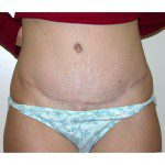 Abdominoplasty 5 After Photo - 12