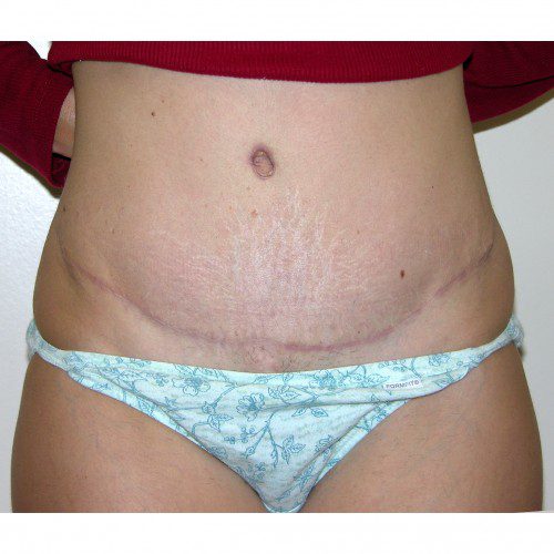 Abdominoplasty 5 After Photo 