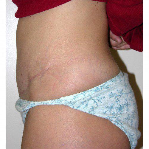 Abdominoplasty 5 After Photo