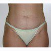 Abdominoplasty 5 Before Photo Thumbnail