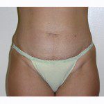 Abdominoplasty 5 Before Photo - 12