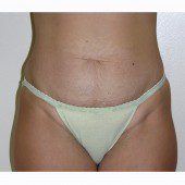 Abdominoplasty 5