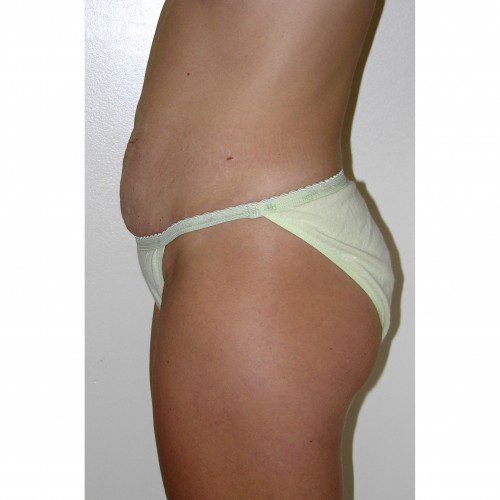 Abdominoplasty 5 Before Photo