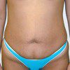 Abdominoplasty 1 Before Photo Thumbnail