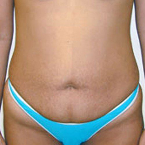 Abdominoplasty 1 Before Photo 