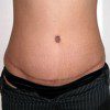 Abdominoplasty 1 After Photo Thumbnail