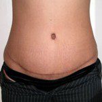 Abdominoplasty 1 After Photo - 3