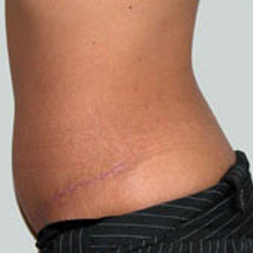 Abdominoplasty 1 After Photo