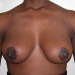 Breast Reduction 01 After Photo - 2