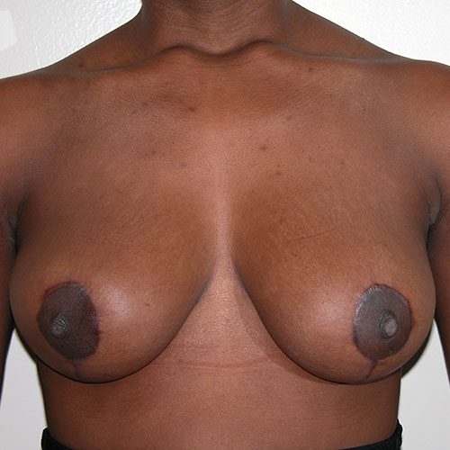 Breast Reduction 01 After Photo 