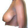 Breast Reduction 01 Before Photo Thumbnail