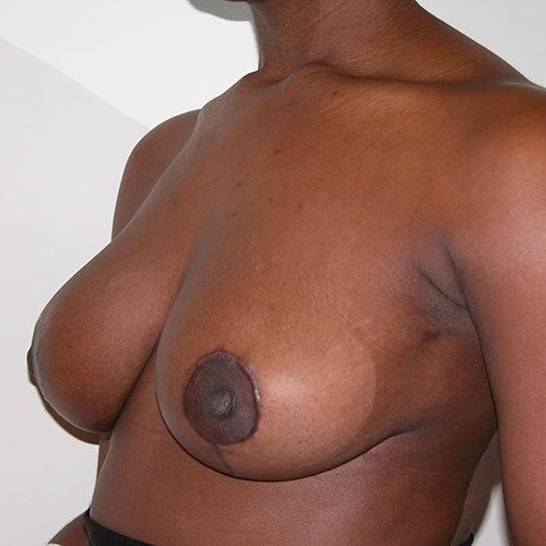 Breast Reduction 01 After Photo