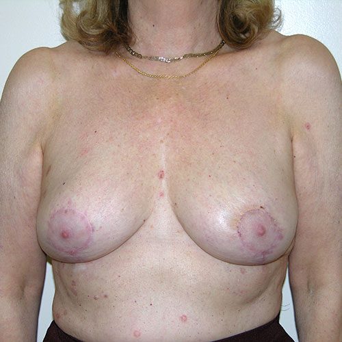 Breast Reduction 02 After Photo 