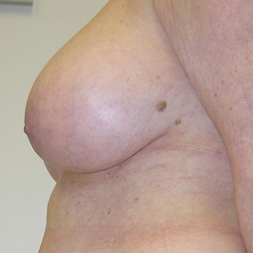 Breast Reduction 02 Before Photo