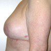 Breast Reduction 02 After Photo Thumbnail