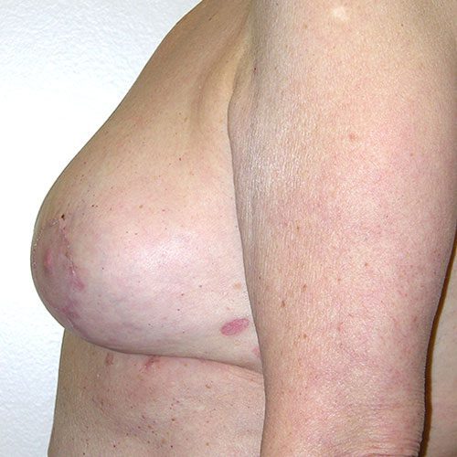 Breast Reduction 02 After Photo