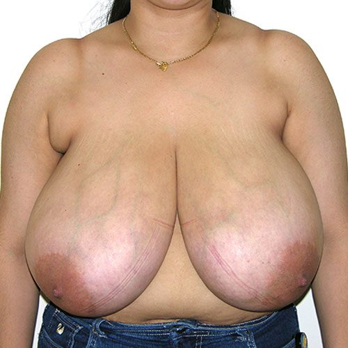 Breast Reduction 03 Before Photo 