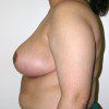 Breast Reduction 03 After Photo Thumbnail