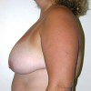 Breast Reduction 04 Before Photo Thumbnail