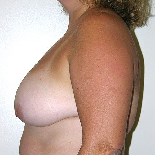 Breast Reduction 04 Before Photo