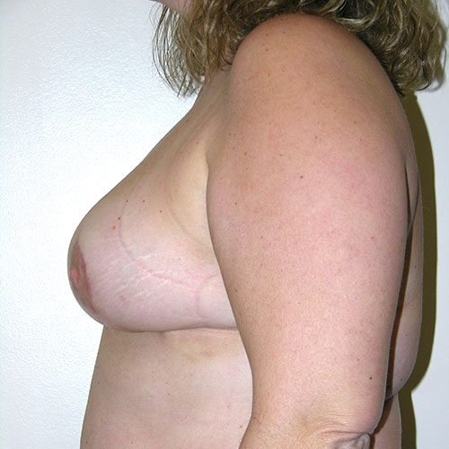 Breast Reduction 04 After Photo