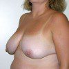 Breast Reduction 04 Before Photo Thumbnail