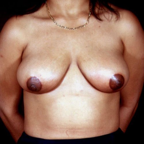 Breast Reduction 07 After Photo 