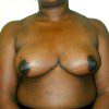 Breast Reduction 09 After Photo Thumbnail