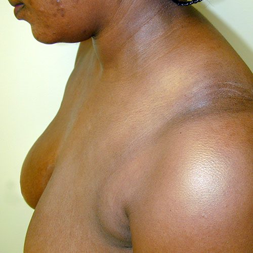 Breast Reduction 09 Before Photo