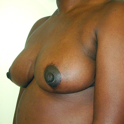 Breast Reduction 09 After Photo