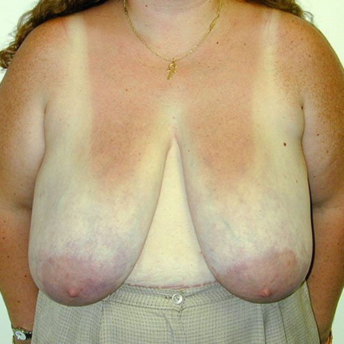 Breast Reduction 10 Before Photo 