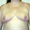 Breast Reduction 10 After Photo Thumbnail