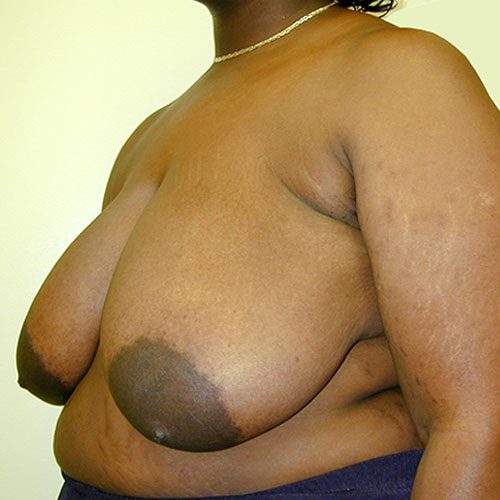 Breast Reduction 12 Before Photo
