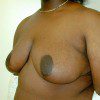 Breast Reduction 12 After Photo Thumbnail