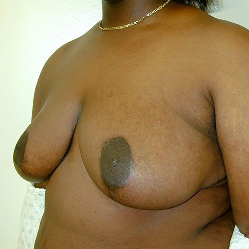 Breast Reduction 12 After Photo