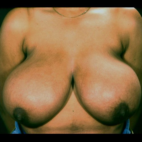 Breast Reduction 14 Before Photo 