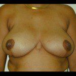 Breast Reduction 14 After Photo - 1