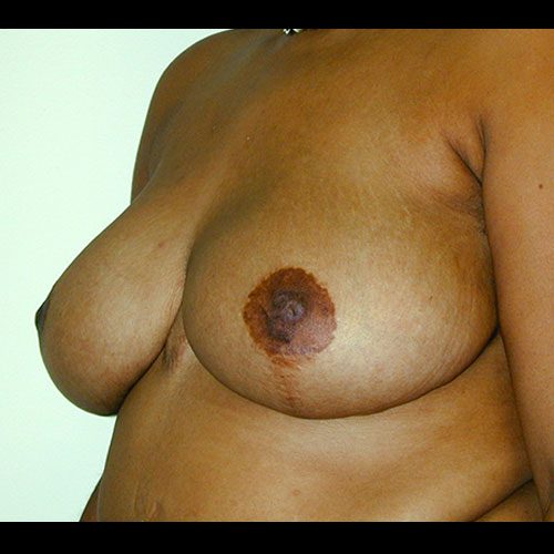 Breast Reduction 14 After Photo