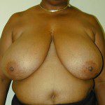 Breast Reduction 15 Before Photo - 12