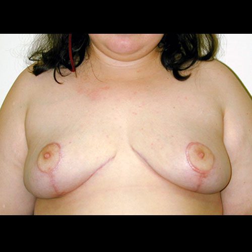 Breast Reduction 16 After Photo 