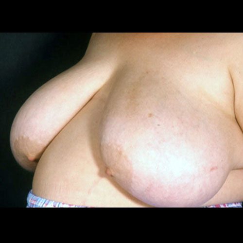 Breast Reduction 16 Before Photo
