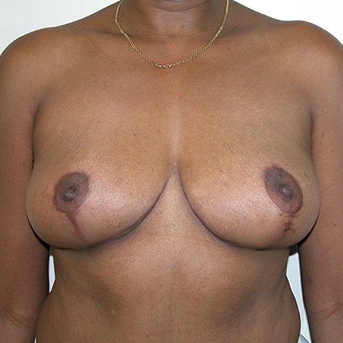 Breast Reduction 17 After Photo 