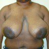 Breast Reduction 19 Before Photo Thumbnail