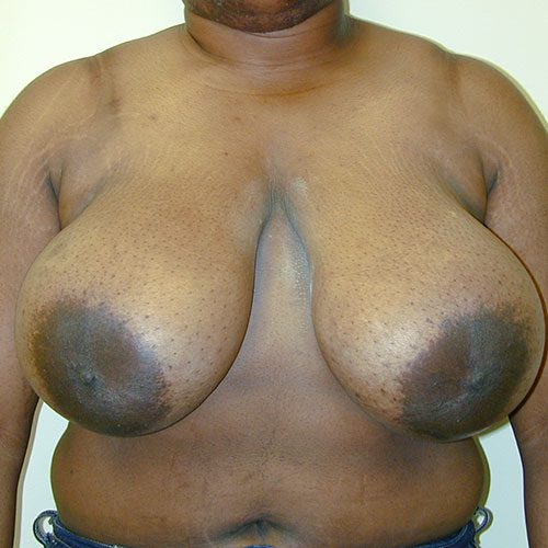 Breast Reduction 19 Before Photo 