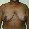 Breast Reduction 19 After Photo Thumbnail
